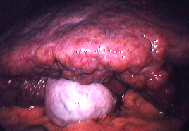 zirrhose.jpg (48302 Byte)